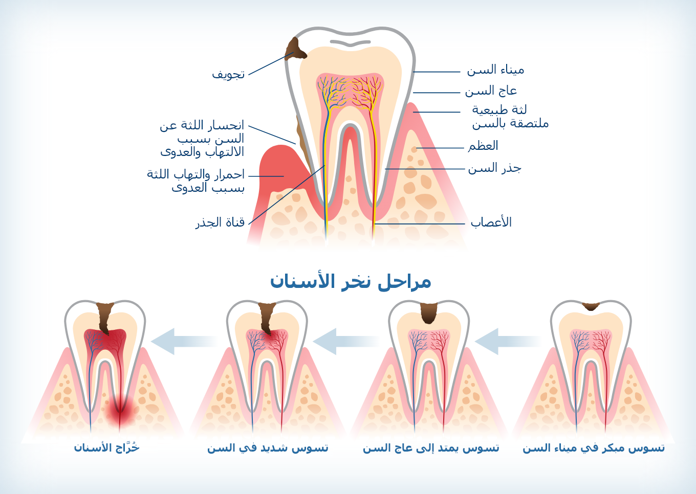 رسم بياني يوضح تقدم نخر الأسنان من مرحلة نخر طبقة المينا المبكرة إلى خُرَّاج الأسنان.