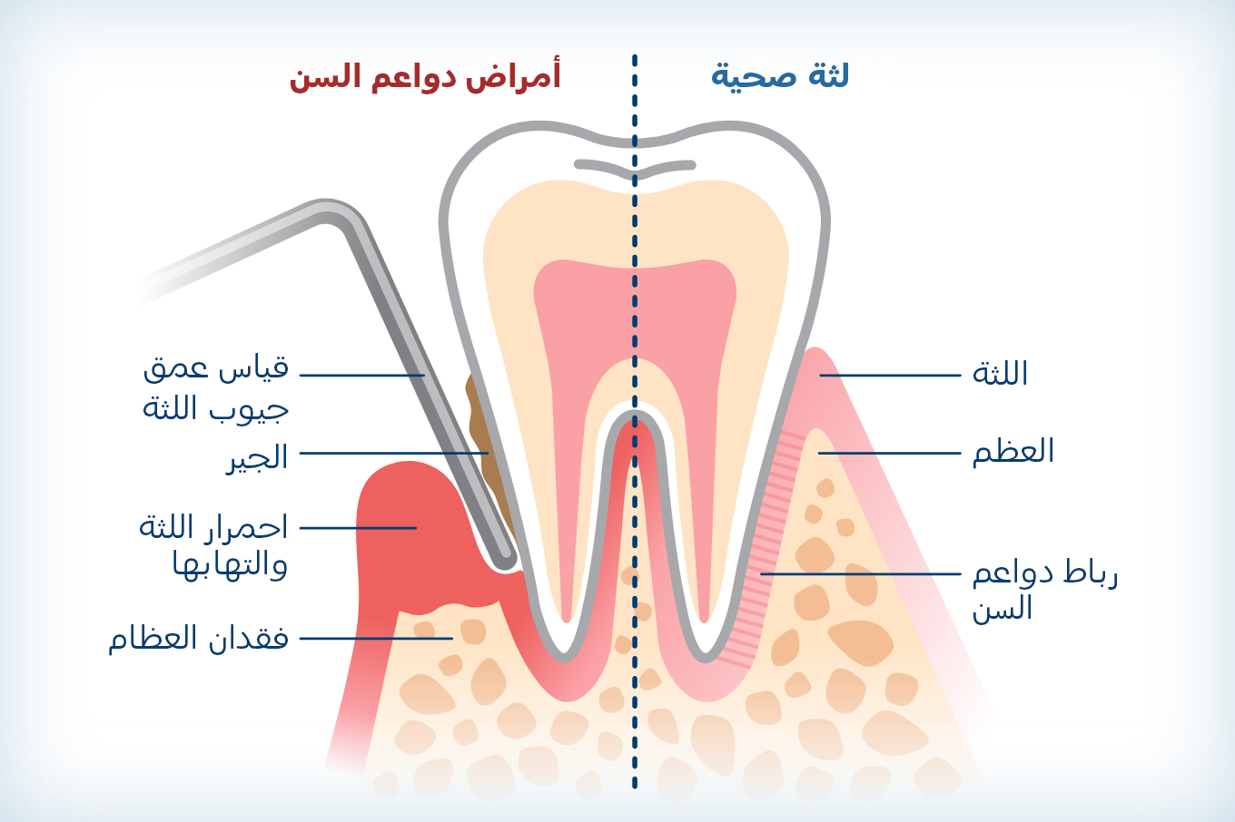 رسم توضيحي يبين الفرق بين الللثة الصحية والمصابة بمرض دواعِم الأسنان.